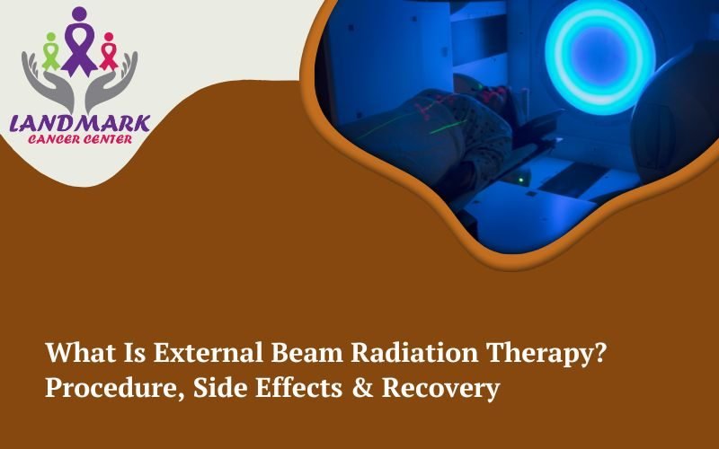 External Beam Radiation Therapy External Beam Radiation Therapy
